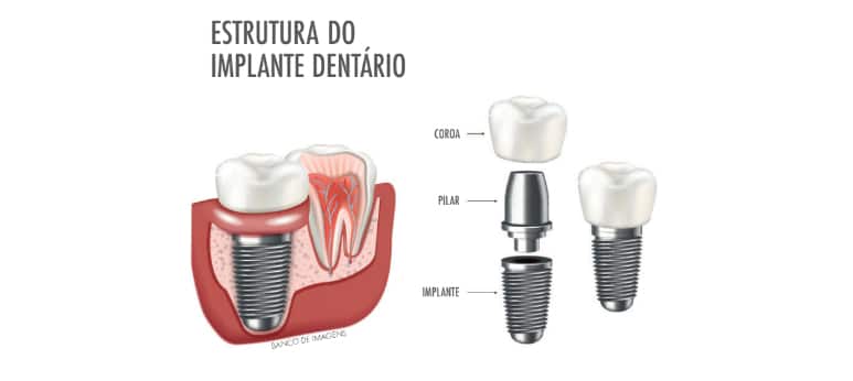 Dentadura nunca mais